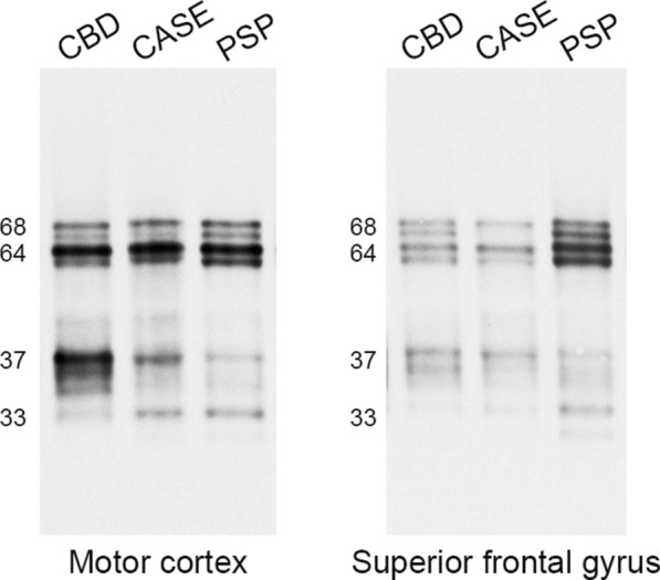 Western blotting of sarkosyl-insoluble tau. As with CBD and PSP, the index case (shown as CASE) has both 68 and 64 kDa bands in the motor cortex and superior frontal gyrus. As low molecular fragments, Case 1 has 37 and 33 kDa in the motor cortex and 37 kDa band in the superior frontal gyrus