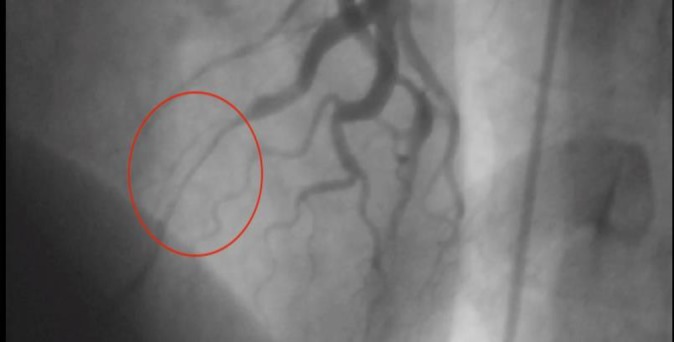 Muscle-bridge in LAD