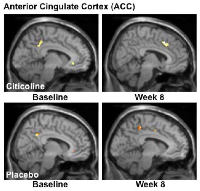 fMRI Analysis of the Multi-Source Interference Task (MSIT): Interference-Control ConditionAnalyses of MSIT (Interference task minus Control task) activation revealed a shift from posterior to more anterior ACC activation, with a corresponding slight increase in total voxel cluster size from baseline to treatment week 8 in the citicoline-treated group. The placebo-treated group also demonstrated activation in posterior ACC at baseline, but following 8 weeks of treatment, activation shifted slightly more anteriorly and remained in posterior and mid ACC. (k = total cluster size with p < 0.01(uncorrected) and a threshold of ≥ 10 voxels).