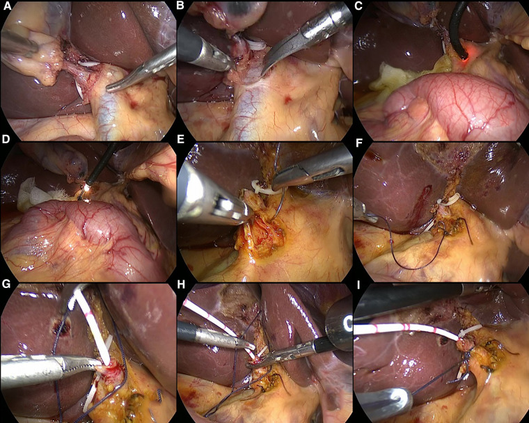 Schematic illustration of laparoscopic choledocholithotomy and C-tube drainage. Figures (A,B) show the morphology of the cystic duct and common bile duct; Figures (C,D) show the process of choledochoscopy and stone removal; Figures (E,F) show the procedure of primary suture of the common bile duct; Figure (G–I) show the process of the insertion of C-duct through the cystic duct.