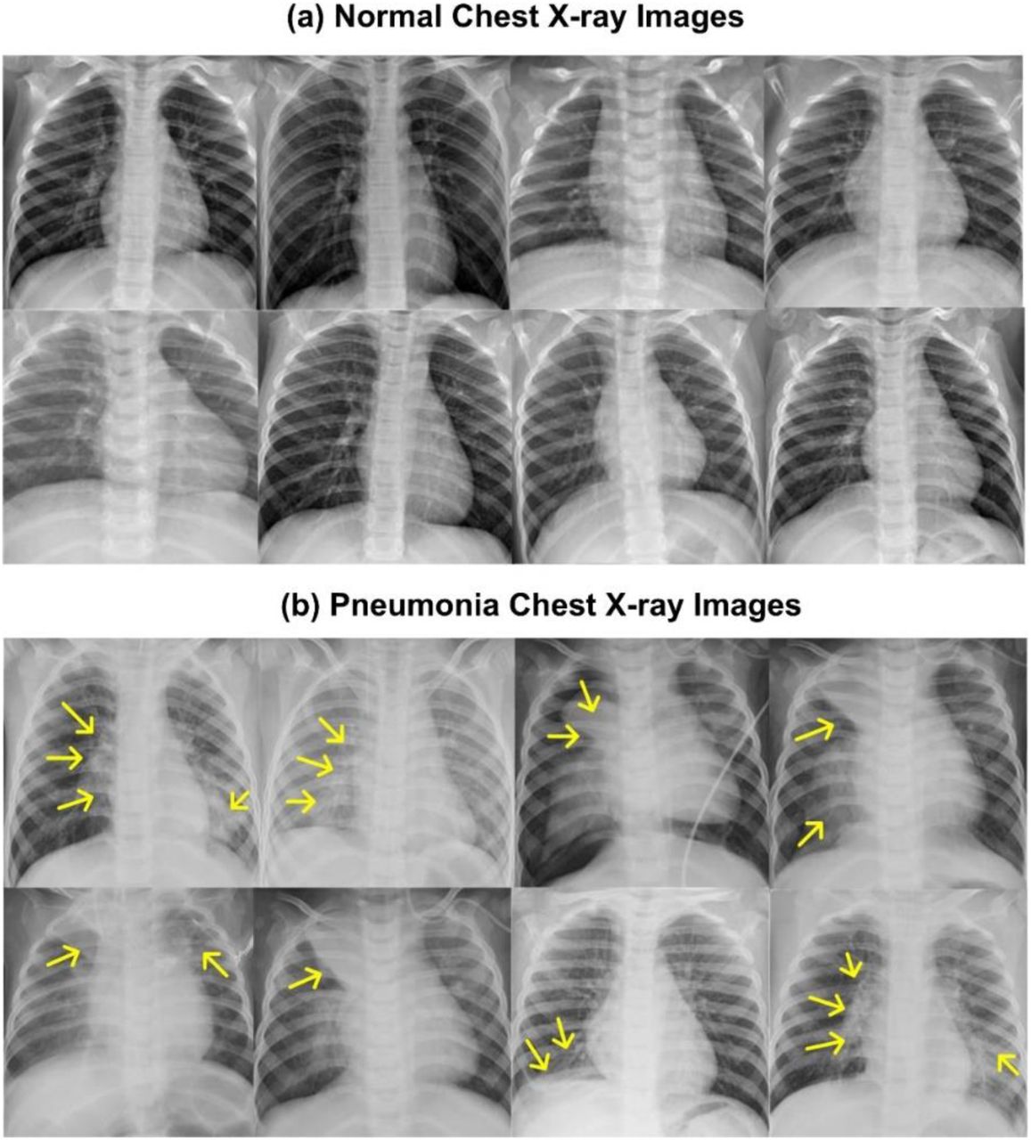 Illustrative represenatation of Chest radiographs (a) A Radiograph showing Normal chest, (b) A Radiograph showing Pneumonia Infected chest