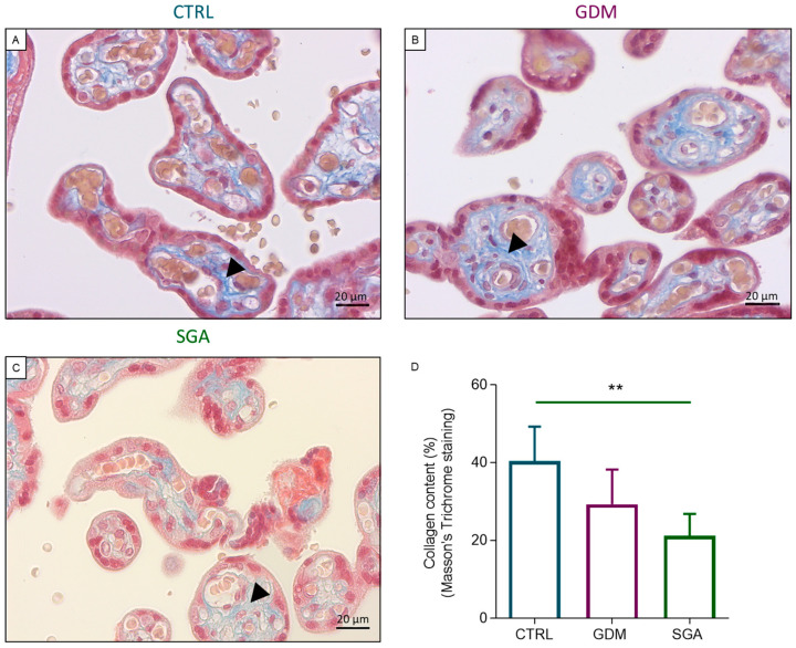 Collagen deposition analysis through histology in the three experimental groups. Masson’s Trichrome staining was performed to analyze the collagen deposition in the CVs (A–C). (D) Bars represent collagen deposition in the three conditions expressed as mean ± SD of five independent samples (n = 5). Asterisks indicate significant differences (** = p < 0.01) Representative histological images of the collagen deposition within the CV (black arrowhead) in CTRL (B), GDM (C), and SGA (D) placentae. CTRL: control group (blue), GDM: gestational diabetes mellitus (purple), SGA: small-for-gestational-age (green).
