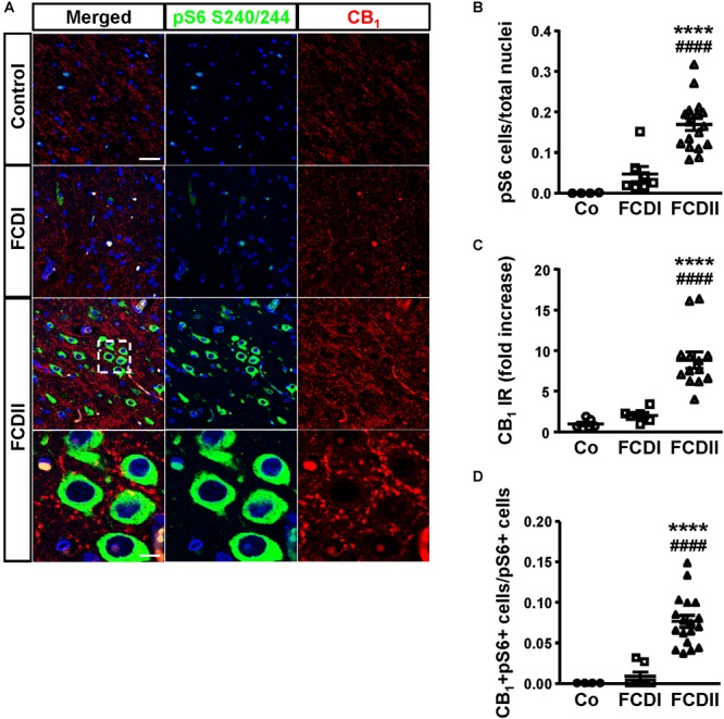 The CB1 receptor is enriched in focal cortical dysplasia (FCD) Type II in cells with overactive mTORC1 signaling. (A) Representative immunofluorescence images showing the presence of CB1 receptors in samples from Type I and II FCD and control brains, revealed with an anti-CB1 antibody (red). Cells with over-active mTORC1 signaling are stained with phospho-S6Ser240/244 antibody (green). High magnification images of CB1 receptor expression associated with mTORC1 overactivation in FCD Type II are shown. (B,C) Phospho-S6+ cells and CB1 receptor immunoreactivity (IR) were quantified in the dysplastic area and referred to total cell number (DAPI counterstaining). Control, FCD Type I and FCD Type II cases (B, n = 4, 7 and 18, respectively; C, n = 6, 8, 13). (D) CB1+ phospho-S6+ double-labeled cells were quantified and referred to total pS6+ cells. Control, FCD Type I and FCD Type II cases (n = 4, 7, and 18, respectively). Statistical comparison versus control samples, ∗∗∗∗p < 0.0001; statistical comparison versus FCD Type I samples, ####p < 0.0001. Scale bar 45 μm, insets, 10 μm.