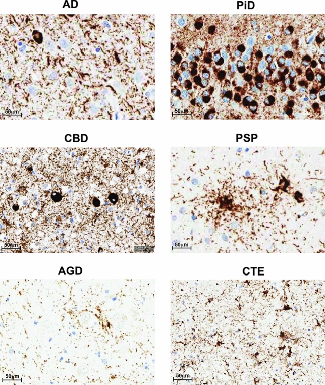 Neuropathology of tauopathies. Representative IHC staining using AT8 on brain sections from different human tauopathy patients AD, CBD, PSP, AGD, PiD and CTE