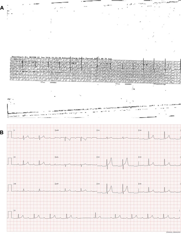 (A) Patient 2: Type 1 second-degree atrioventricular block (Wenckebach conduction) with a single junctional escape beat every time when atrioventricular conduction is blocked. (B) Patient 2. Type I second-degree atrioventricular block.