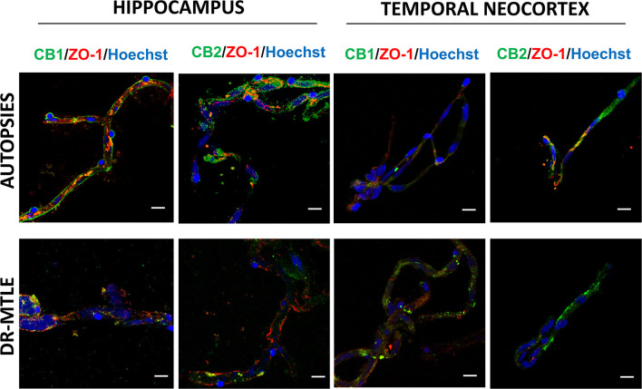Double-labeling immunofluorescence staining of zonula occludens-1 (ZO-1) and CB1 or CB2 in MECs isolated from the hippocampus and temporal neocortex of non-epileptic autopsies and patients with DR-MTLE. Cell nuclei were stained with Hoechst (in blue). Notice the low ZO-1 staining colocalization with low (hippocampus) and high (temporal neocortex) CB1 and CB2 staining in MECs of patients with DR-MTLE. All scale bars are 20 μm.
