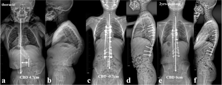 a 12-year-old boy with NF1 related thoracic kyphoscoliosis associated with CCI (thoracic type) (a, b). Halo gravity traction on wheelchair was prescribed for 1 month. Afterwards, posterior spinal correction and fusion surgery was performed (c, d), and the CCI improved from 4.7 cm to − 0.7 cm postoperatively (c, d). At 2-year-follow up, the CBD got further improvement to 0 cm (e, f)