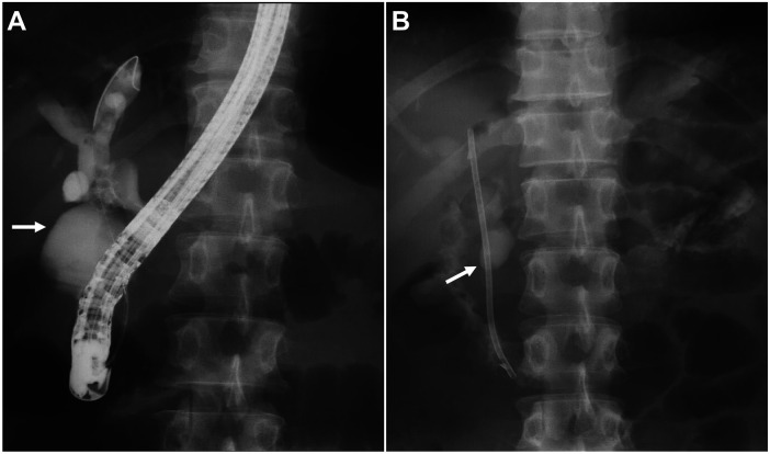 Two-panel fluoroscopic images from endoscopic retrograde cholangiopancreatography (ERCP). Panel A shows a contrast-opacified biliary tree with compensatory dilatation of the common bile duct, no residual stones in the biliary tract; a white arrow marks early opacification of the duodenal lumen, confirming a choledochoduodenal fistula. Panel B shows the same anatomical region after implantation of a 7 Fr × 12 cm plastic biliary stent (white arrow), with contrast medium flowing from the bile duct into the duodenal lumen.