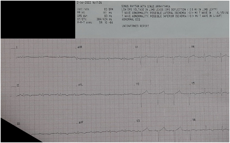 The patient’s electrocardiogram indicating sinus rhythm, a rate of 83 beats per minute with small voltage complexes, and nonspecific ST-T changes such as T-wave inversions in leads V5-V6, II, III, and aVF.