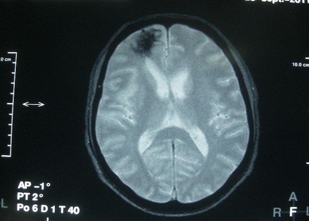 Brain MRI showing hypointensity of the right fronto-polar region on T2* image