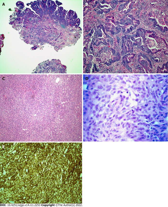 Histopathology of the surgically resected ampullary mass and ileal mass. A: Low-power micrograph of invasive adenocarcinoma arising from a tubulovillous adenoma with high-grade dysplasia in the ampullary region (hematoxylin and eosin stain, original magnification 20 ×); B: High-power micrograph of ampullary mass showing malignant glands (hematoxylin and eosin stain, original magnification 100 ×); C: Low-power photomicrograph of ileal mass showing the spindle cell morphology of a gastrointestinal stromal tumor (GIST) (hematoxylin and eosin stain, 100 × original magnification); D: A high-power view of cellular mitosis within the ileal GIST (hematoxylin and eosin stain, 600 × original magnification) showed 15 mitoses per 5 square millimeters; E: Immunohistochemical staining for CD117 showing strong and diffuse cytoplasmic immunoreactivity confirming GIST (hematoxylin and eosin stain, 100 × original magnification).