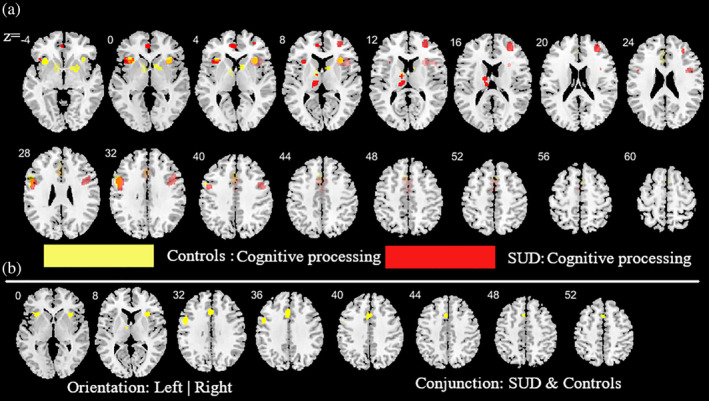 Additional analysis aimed at mapping alterations in SUD (across all substances) relative to controls as well as common activities between SUD and controls during cognitive task paradigms. (a) subtraction ALE comparing SUD and controls during cognitive task paradigms. Yellow (controls > SUD); Red (SUD > controls). (b) Conjunction ALE maps for cognitive task paradigms between SUD and control participants. Displayed at FWE < 0.05