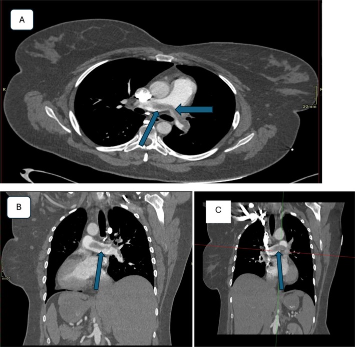 CT pulmonary angiogram showing an acute saddle pulmonary embolus. (A) Axial. (B) and (C) Coronal sections.