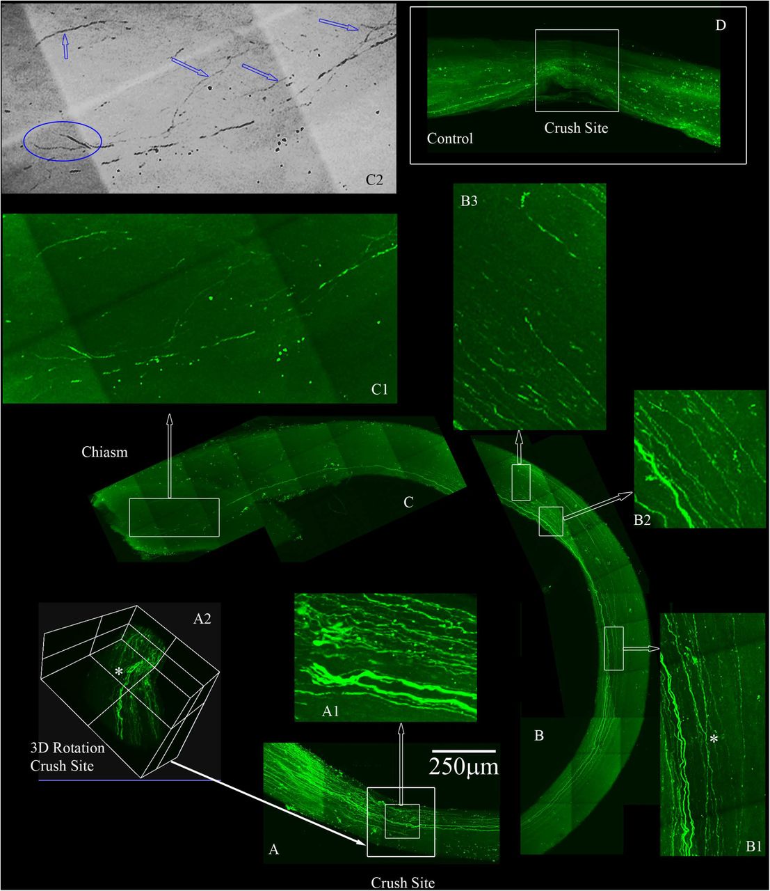 Four-Drug treatment promotes robust axonal regeneration in the rat optic nerve crush model as detected by AAV8-GFP labeling.Adult Sprague-Dawley rats had optic nerve crushes and received gelfoam soaked with APC and Taxol applied over the injury site with IL-6 and HU-210 intra-vitreal injections immediately after the crush. We labeled the regenerating axons with AAV8-GFP injected intra-vitreally to the RGC cell bodies 2 weeks prior to euthanizing. The optic nerves are immunolabeled by iDISCO with anti-GFP and then chemically cleared. A. Crush site of the nerve of displaying regenerating fibers expressing GFP. The inner box is magnified in A1, displaying tortured growing axons in the center of the nerve (inner box with traced white arrow). A2, is a 3D rendering of the nerve at the crush site (outer white box in A shown by filled white arrow) that is rotated on its axis to emphasize regenerating axons are not growing on the edges but more in the center of the nerve (see asterisk). B. Continuation of the nerve displaying GFP expressing axons that are growing in the center of the nerve and even crossing over in B1 (see asterisk). B2 and B3 are magnified regions with GFP labeled axons over 4mms away from the crush site. C. We detect GFP labeled axons into the chiasm of the nerve and the end of the chiasm, we have a magnified region in C1. The image in C1 was converted to grayscale to remove the color and then the image was inverted in C2, to emphasize the tortured growth into the chiasm as demarcated by the blue arrows and the bifurcation (blue circle in C2) of the axons growing into the chiasm. D. An example of an adult rat that only received vehicle controls and no GFP labeled axons are displayed past the crush site. All images are taken on an Olympus Multiphoton microscope with a 25X water immersion lens. The images in A1, B1-3 and C1 are taken at 25x with a 1.5x Zoom. Micrometer of 250microns is shown in A.