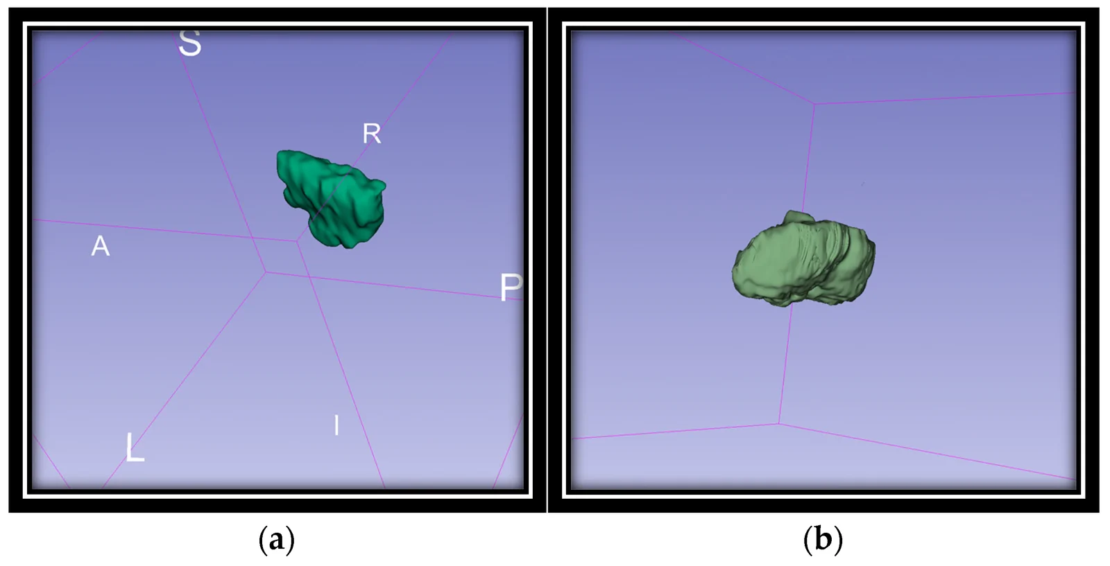 3D manual segmentation (3D Slicer) at 9-month follow-up tracking the (a) cerebellar vermis and (b) total cerebellum during LAI aripiprazole maintenance.