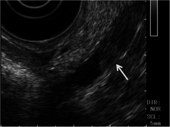 Endoscopic ultrasonography demonstrated an elevated lesion (arrow) of DBD