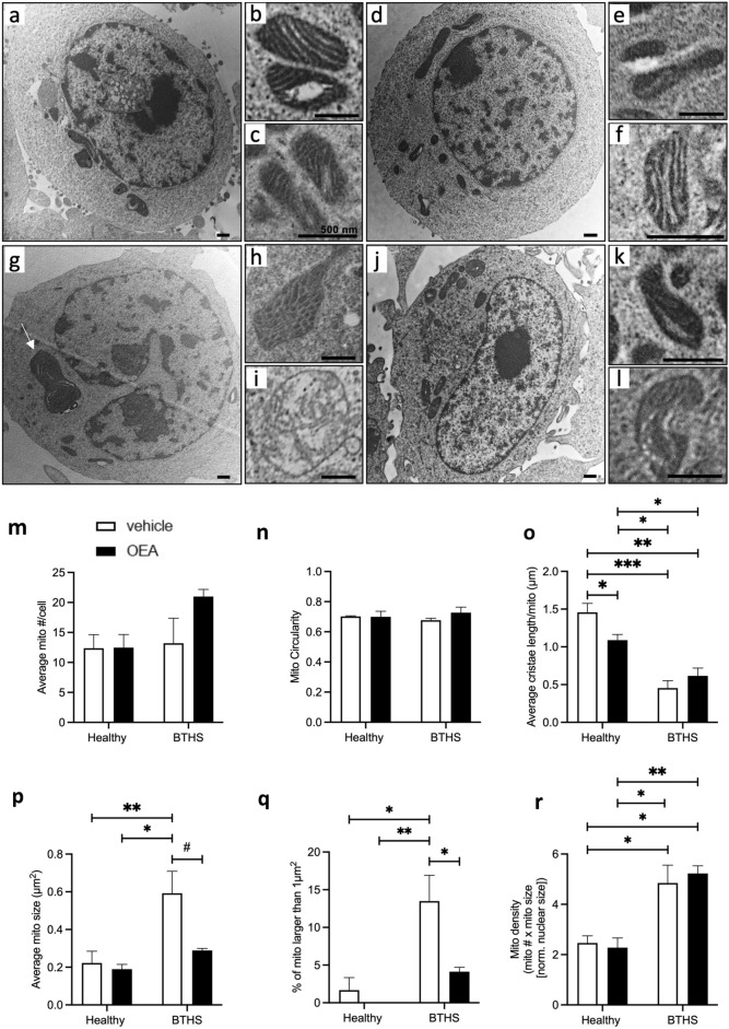 BTHS lymphoblasts have larger mitochondria that are reduced in size to healthy lymphoblast levels by OEA treatment. Representative whole cell and subcellular mitochondrial images are shown for vehicle-treated healthy lymphoblasts (a–c), 1 µM OEA-treated healthy lymphoblasts (d–f), vehicle-treated BTHS lymphoblasts (g–i), and 1 µM OEA-treated BTHS lymphoblasts (j–l). The white arrow in (g) shows a characteristic, atypically enlarged mitochondrion from a BTHS lymphoblast, while the image in (h) shows a mitochondrion with a ‘bubbly’ appearance, and the image in (i) shows a mitochondrion with an ‘onion-like’ appearance. Quantitative measures were derived from images produced from three of the BTHS and healthy lymphoblast lines after either vehicle treatment or treatment with 1 µM OEA for 4 days. The average number of mitochondria per cell (normalized to nuclear area to account for differences in cross-sectional area) is shown (m). Measures of mitochondrial morphology, including mitochondrial circularity (n), average total parallel cristae length per mitochondrion (o), average mitochondrial size (p), and the prevalence of atypically large mitochondria (q) are also reported. Scale bars = 500 nm. Data are means ± S.E.M; n = 3. #P = 0.06, *P < 0.05, **P < 0.01, ***P < 0.001.