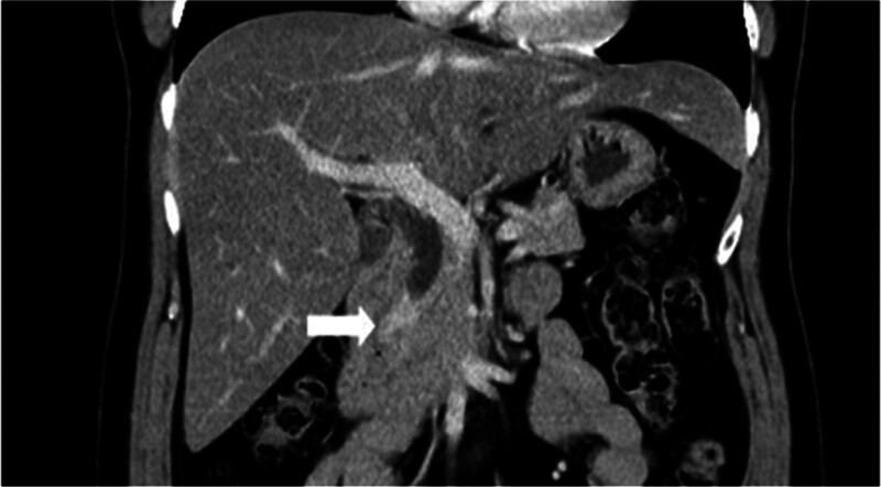 CT showed enhanced thick wall and tumor-like mass about 1.6 cm over distal common bile duct (arrow). CT = computed tomography.