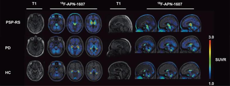 Representative [18F]-APN-1607 (or [18F]PM-PBB3) PET images superimposed on T1 MRI in PSP patients versus PD and controls. Compared to PD and HC, patients with PSP display heightened tracer binding in the midbrain, basal ganglia, subcortical nuclei, and brainstem. The colour scale represents standardized uptake value ratio (SUVR) with cerebellar cortex as the reference regions. PSP-RS = progressive supranuclear palsy-Richardson’s syndrome, PD = Parkinson’s disease, HC = healthy controls. Figure modified from Li L, Liu FT, Li M, Lu JY, Sun YM, Liang X, Bao W, Chen QS, Li XY, Zhou XY, Guan Y, Wu JJ, Yen TC, Jang MK, Luo JF, Wang J, Zuo C; Progressive Supranuclear Palsy Neuroimage Initiative (PSPNI). Clinical Utility of 18F-APN-1607 Tau PET Imaging in Patients with Progressive Supranuclear Palsy. Mov Disord. 2021 Oct;36(10):2314–2323. https://doi.org/10.1002/mds.28672. Epub 2021 Jun 5. PMID: 34089275.