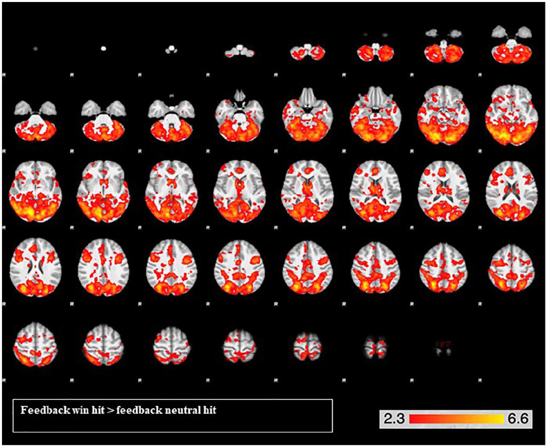 Widespread brain activation for the reward feedback contrast across both drug conditions, with peak activations in the left occipital fusiform gyrus and the right precentral gyrus. From the top left, slice images progress upward, on a ventral-dorsal trajectory. The colours represent z values.