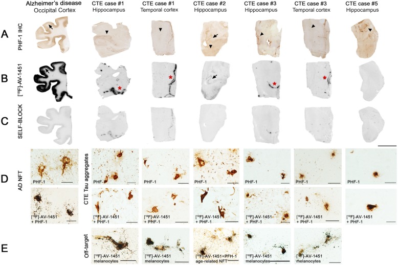 Representative images of immunohistochemistry with PHF-1 antibody (panel a), [18F]-AV-1451 phosphor screen autoradiography (panel b), self-block (panel c), and [18F]-AV-1451 nuclear emulsion autoradiography followed by PHF-1 immunostaining in AD (positive control) and CTE brains (panels d and e). A strong [18F]-AV-1451 binding signal was observed in cortical regions containing tangles in AD (panels a and b arrows). No [18F]-AV-1451 binding was detected in CTE slices containing abundant tau aggregates (panel a arrowheads) with the exception of strong binding to the choroid plexus in case#1 and to leptomeninges in cases #1 and #3 (panel b red stars) corresponding to off-target to leptomeningeal melanocytes. A weaker signal was present in hippocampus of case #2 (panel b arrow) where scarce classic AD NFTs (panel a arrow) were present along with abundant CTE tau aggregates (panel a arrowhead). The signal was blocked by adding unlabeled AV-1451 (panel c). [18F]-AV-1451 nuclear emulsion autoradiography confirmed a strong accumulation of silver grains colocalizing with classic NFTs in AD (panel d), and with incidental classic NFTs in the hippocampus of CTE case #2 (panel e). No detectable accumulations of silver grains were observed in association with CTE tau aggregates (panel d). Strong accumulation of silver grains also colocalized with leptomeningeal melanocytes in CTE cases #1 and #3 (off-target binding) (panel e). Scale bars = 1 cm (panels a, b, c) and 20 μm (panels d and e)