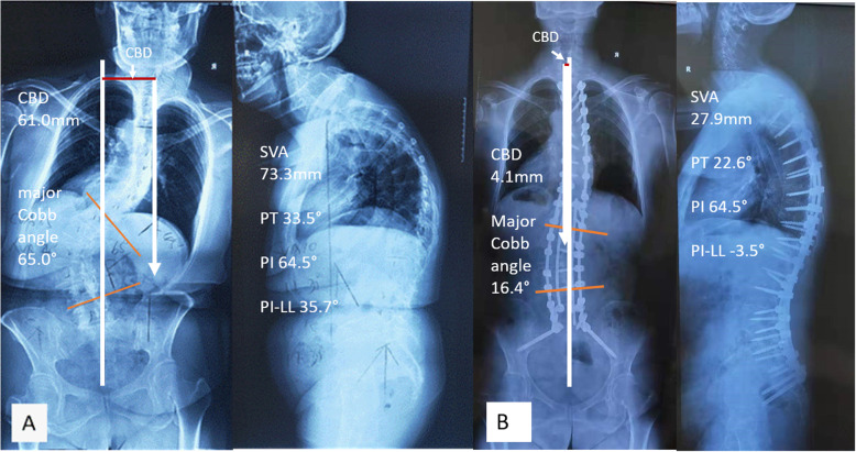 classic case, a 52-year-old lady. Pre-operative (a) and post-operative (b) standing posteroanterior and lateral radiographs after IGCA technique. IGCA: integrated global coronal aligner