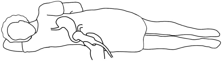 Patient in the right lateral decubitus position for gastric ultrasonography. Drawing designed by authors.