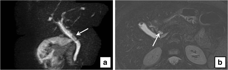 a Sagittal thick-slab magnetic resonance cholangio-pancreatography (MRCP) shows a filling defect in a dilated common bile duct (CBD) (arrow). b Axial fat-saturated T2-weighted magnetic resonance imaging (MRI) of the same patient shows a dishomogeneous filling defect in a dilated CBD (arrow)