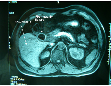 Spiral CT with evidence of pneumobilia and suspicion of cholecystocolic fistula.