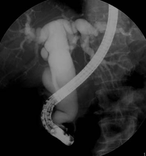 ERCP shows severe stenosis of the distal portion of the CBD and marked proximal dilation. The main pancreatic duct is not dilated.