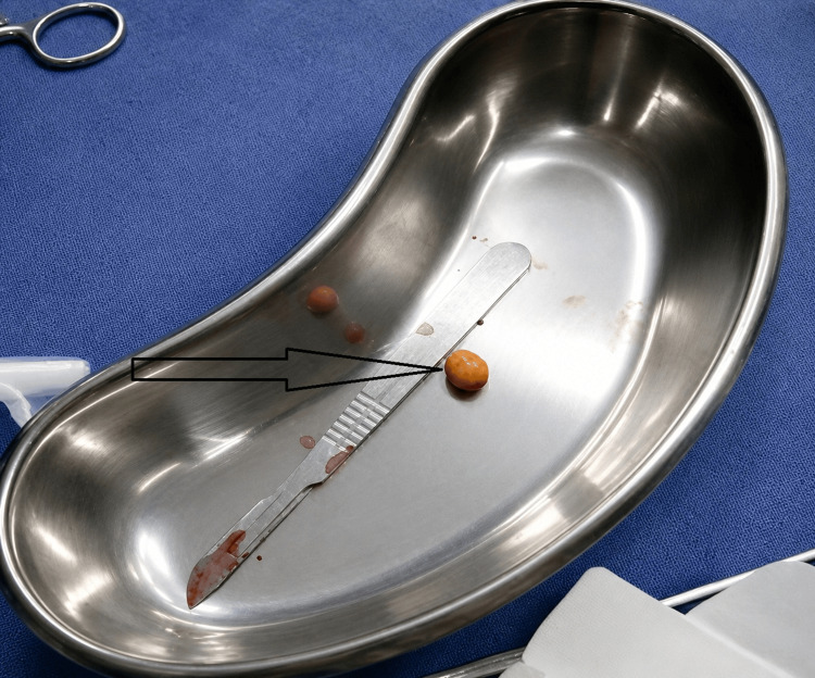Intraoperative specimen demonstrating an extracted cystic duct stump stone placed on a surgical tray (arrow indicating the calculus).