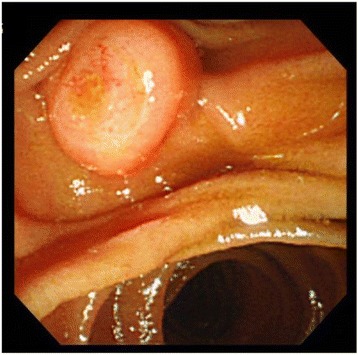 EGD reveals mildly swollen and protruded papilla of Vater, with no mucosal erosion. Cancer cells are not found in the biopsy specimen