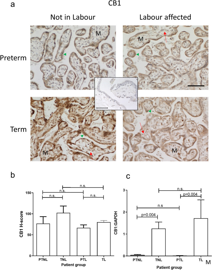Effect of labour and prematurity on protein and CB1 transcript expression and levels. Representative photomicrographs of villous trophoblasts from ten images taken for each patient within each of the four patient groups (n = 6 samples per group) are shown in panel a. Images were obtained at 200× magnification; insert shows IgG negative control obtained at 40× magnification; bar, 50 μm. M indicates the mesenchymal core, whilst the green arrowhead points to the syncytiotrophoblast layer. Foetal capillaries within the mesenchymal cores are shown by the red arrows. Panel b shows the results of histomorphometry analyses of the 240 CB1 immunoreactivity images for the four different patient groups. Differences between groups were calculated using one-way ANOVA; n.s. non-significant. Panel c shows the levels of CB1 mRNA corrected for the levels of GAPDH. Data are presented as the mean ± SEM of six patient samples in each group, with each sample examined in triplicate. Differences in expression levels was determined using one-way ANOVA with Dunnett’s T3 multiple comparisons tests; p-values are shown for significant comparisons