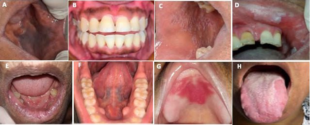 Oral mucosal lesions in the study population. a) Smoker Melanosis. b) Physiologic Melanin Pigmentation. c) Oral Lichen Planus. d) Oral Leukoplakia. e) Actinic Cheilitis. f) Mandibular Exostosis. g) Inflammatory Papillary Hyperplasia. h) Benign Migratory Glossitis (geographic tongue).
