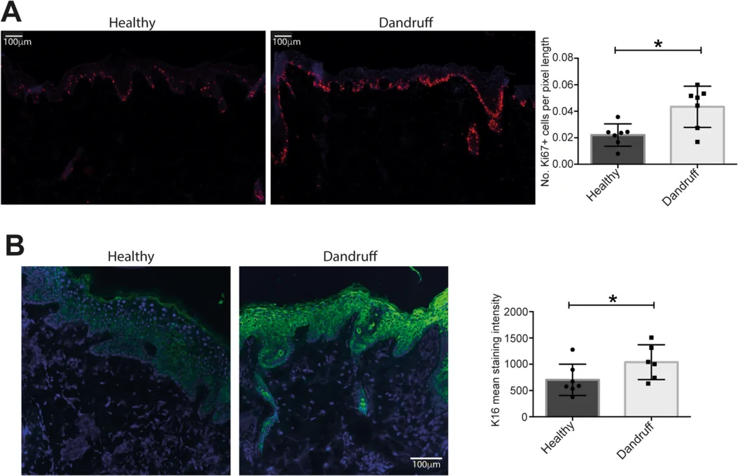 Keratinocytes in dandruff‐affected scalp are hyperproliferative and show altered differentiation. Healthy and dandruff skin scalp sections were analysed for Ki67 (A) and Keratin 16 (B). Representative images and summary data are shown. Keratin 16 staining intensity between hair follicles, and the number of Ki67‐stained cells in the basal layer, per pixel length of a line drawn through the basal layer, were quantitated using ImageJ. Scale bars represent 100 µm, n = 7, *p < 0.05.