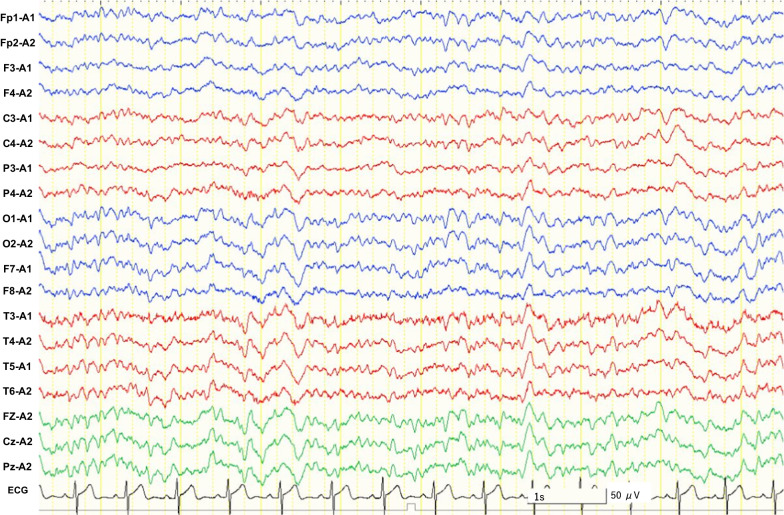 Interictal electroencephalogram (EEG). Interictal EEG showed a mixture of sharp slow-wave complexes and sharp waves. EEG displayed at 7 µV/mm, HFF 70 Hz, and LFF 1 Hz. Calibration bars equal 50 μV vertical and 1 s horizontal