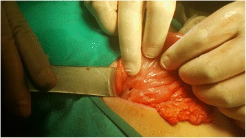 Perforated area of the first part of the duodenum