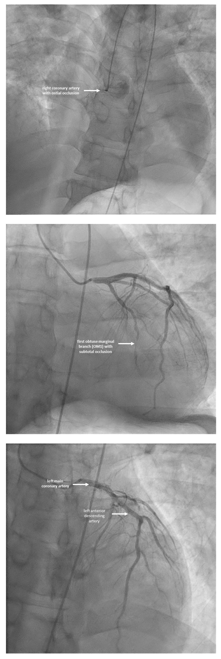 Coronary angiographic findings demonstrating right coronary artery with ostial occlusion and obtuse marginal branch subocclusion; No critical stenosis on the left coronary system.