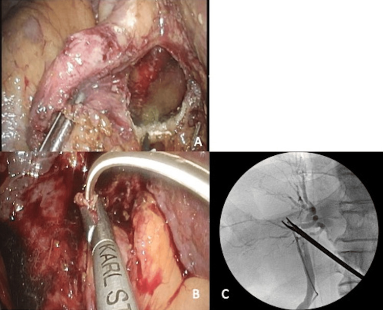 Case 2: Surgical findings and procedures.Surgical findings and procedures. (A) Because the gallbladder was deeply embedded within the liver, total cholecystectomy was not feasible; the gallbladder stones were removed while leaving the posterior wall attached to the gallbladder bed. (B) Cholangiography was performed via a C-tube inserted through the cystic duct. (C) Intraoperative cholangiography showed no leakage from the common bile duct (CBD).
