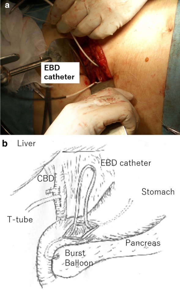 a, b The surgical findings. The burst balloon of the EBD catheter was removed during the surgical procedure. An incision at the pylorus was made to remove the EBD catheter through the incision