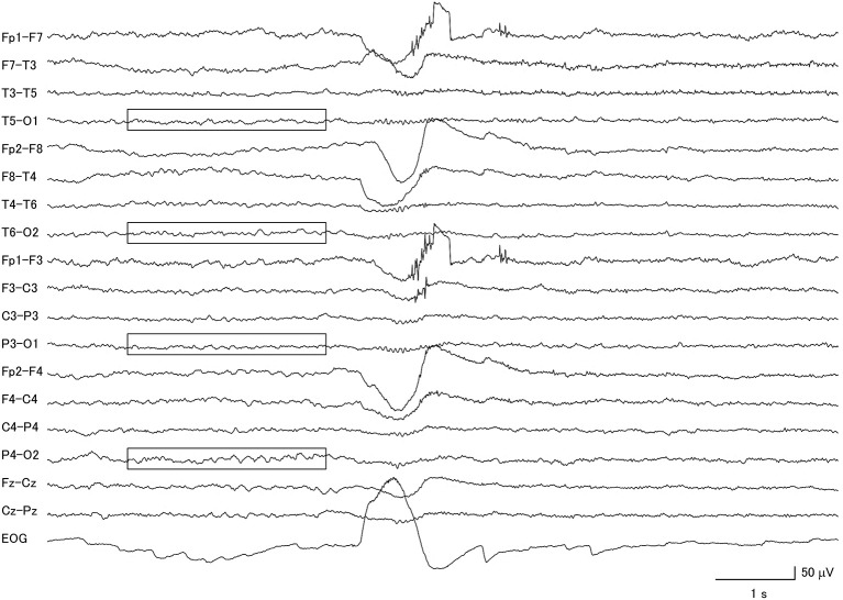 Electroencephalogram of a patient with corticobasal degeneration, demonstrating very low voltage patterns (within boxes). Notice that the background activity is also asymmetric.
