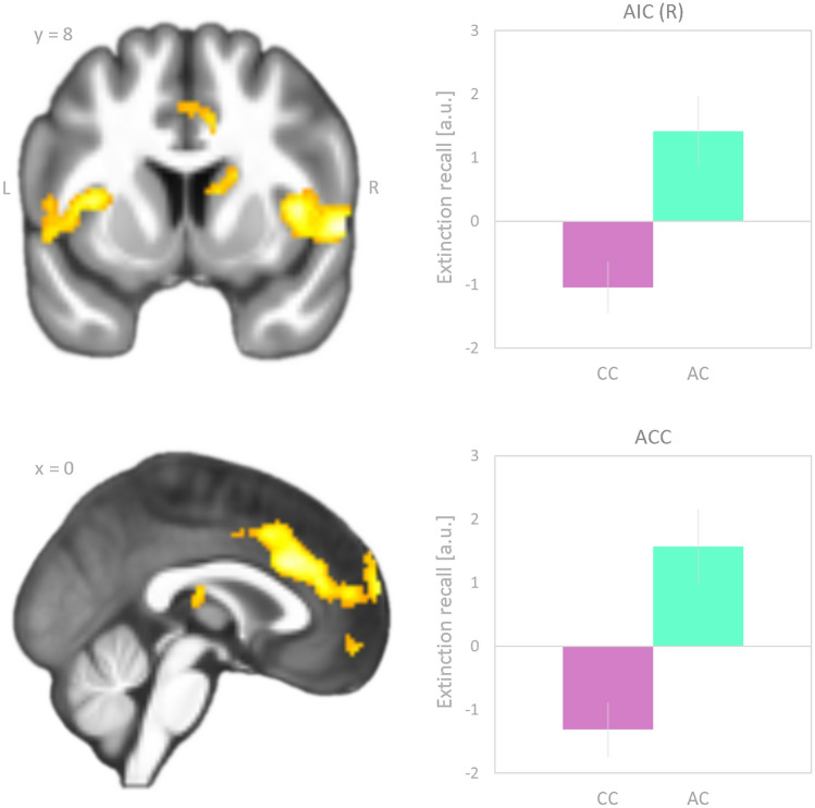 Brain regions where carriers of the FAAH A-allele, relative to CC homozygotes, displayed a significantly greater effect of extinction recall, defined as the difference “CS+b (unextinguished) minus CS+a (extinguished)”. As previously introduced [21, 41, 42], a positive going contrast value indicates extinction recall, while a negative going contrast value indicates the reverse. This is exemplified by the bar graphs on the right side of the figure, for two representative brain regions, the right anterior insula (AIC) and the anterior cingulate cortex (ACC). Significance was assessed at p < 0.001 (voxel level) and p < 0.05 (cluster level FWE corrected, corresponding to 173 voxels). The statistical parametric map was superimposed on coronal and sagittal sections of the group averaged T1 image. Coordinates refer to Montreal Neurological Institute (MNI) space. Differential parameter estimates were extracted from the right anterior insula (869 voxels; upper right panel) and the anterior cingulate cortex (2341 voxels; lower right panel). a.u. arbitrary unit; L left; R right