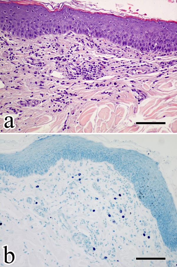 Skin histopathology of dogs with AD. a) Regular epidermal hyperplasia with mild spongiosis and superficial perivascular infitrate composed of lymphocytes, MCs and a few neutrophils; H&E stained section; b) Toluidine blue stained section showing methacromatic MCs infiltrating the superficial dermis. Scale bars = 100 μm.