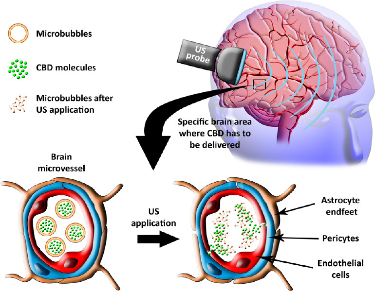 Representative image of microbubbles CBD-loaded and delivered in specific brain area by US application.US waves are directed to the brain region where CBD needs to be carried; when the CBD-loaded circulating microbubbles are hit by the US waves, they break and release the CBD exactly in the brain region where the waves have already partially opened the BBB. BBB: Bloodbrain barrier; CBD: cannabidiol; US: ultrasound.