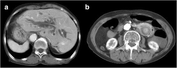 a Diffuse dilatation of biliary tree with multiple intrahepatic duct stones and CBD stones. b CT revealed situs inversus totalis