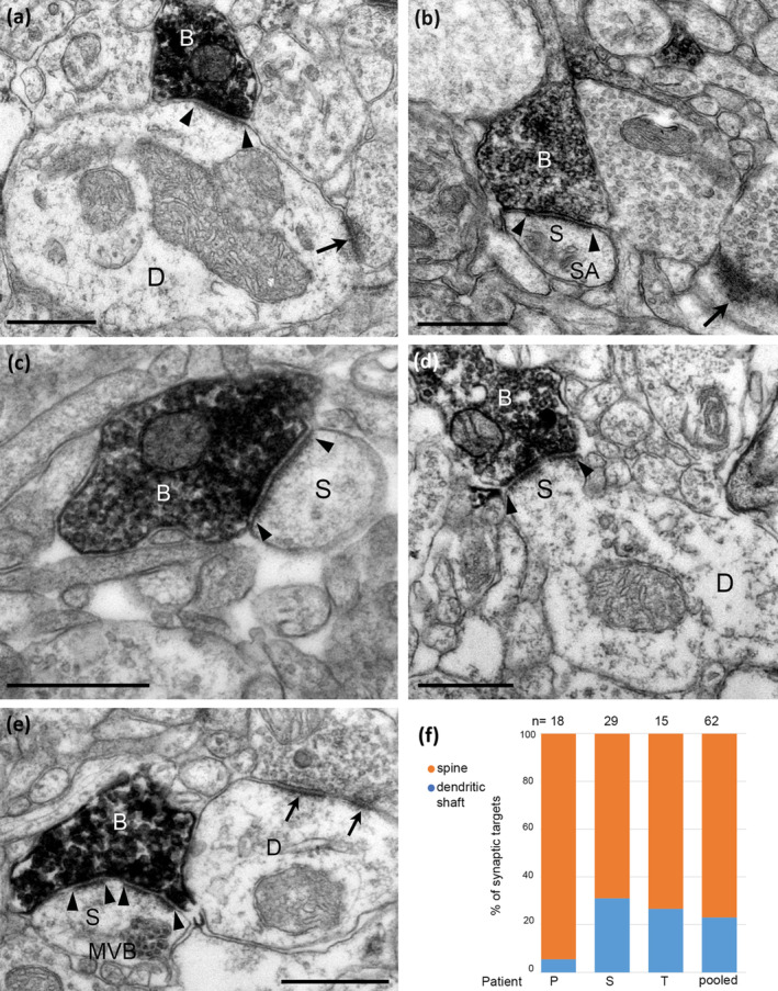 Electron micrographs of the synaptic targets and quantitative distribution of VGLUT3 expressing nerve terminals forming type‐1 synapses. Immunoperoxidase reactions show VGLUT3‐positive terminal boutons (B) filled with electron‐opaque DAB‐deposit (black); the synaptic junctions are marked by arrowheads. (a) A large dendritic shaft (D) receives a type‐1 synapse from VGLUT3‐positive bouton and an additional type‐1 synapse from an unlabelled terminal (arrow). (b–e) Dendritic spines as synaptic targets. In (b) the spine (S) has a spine apparatus (SA) and another spine also receives a type‐1 synapse (arrow); in (d) the innervated sessile spine (S) originates from a dendritic shaft (D); in (e) the spine (S) contains a multivesicular body (MVB) and the VGLUT3‐positive bouton makes a perforated synapse as does a nearby bouton (arrows) with a dendritic shaft (D). (f) Quantification showing that most of the synaptic targets of type‐1 synapses were dendritic spines and far fewer were dendritic shafts in samples from three patients. Scale bars: (a–f), 0.5 μm.