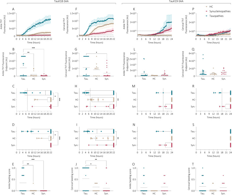 TauK18- and TauK19-SAA analyses at ankle and cervical sites in tauopathies, synucleinopathies, and healthy controls.Kinetic curves of TauK18 and TauK19 seeding activity in ankle (A, K) and cervical (F, P) sites, respectively. Each dot represents the mean (±SE) of the ThT fluorescence intensity of all samples tested per group against time. The dotted line indicates the selected threshold at 10.000 arbitrary units (AU). B, G, L, Q Scatter plot of final ThT fluorescence intensities: dots represent mean values of final ThT fluorescence intensity for individual patients and bars the mean of the group. C, H, M, R Box and Whisker Plot showing the Lag time defined as the reaction time required to pass the threshold of 10.000 AU. The dotted line shows the selected time points (7 h for TauK18 or 18 h for TauK19) to define the positive and negative subjects. D, I, N, S Box and Whisker Plot showing the T50, defined as the reaction time required to reach 50% of maximum fluorescence detected. E, J, O, T Seeding score defined as the number of replicates out of three that cross the threshold of 10.000 AU at 7 h. Each dot represents a patient and bars the mean of the group.