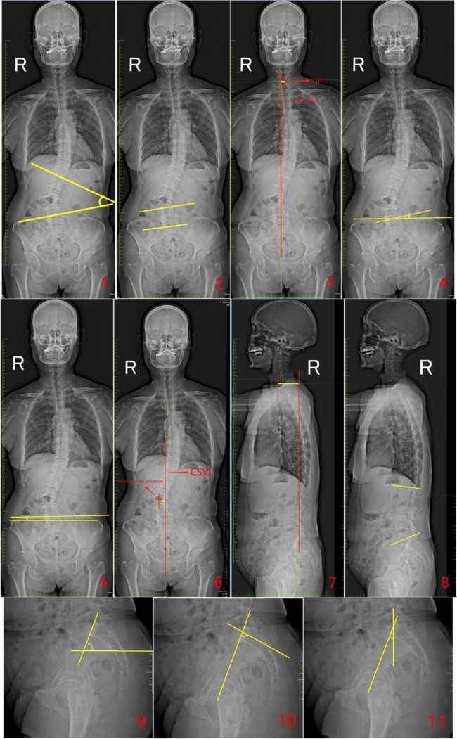 Spine X-ray full length photogrammetry diagram. Figure1-1. The angle between the two yellow lines is the Major Curve (MC). Figure 1−2. The angle between the two yellow lines is the Fractional Curve (FC). Figure 1−3. The yellow line represents the Coronal Balance Distance (CBD). Figure 1−4. The angle between the two yellow lines is the L5 Tilt Angle (L5TA). Figure 1−5. The angle between the two yellow lines is the Coronal Pelvic Inclination (CPI). Figure 1−6. The yellow line indicates the Apical Vertebra Translation (AVT). Figure 1−7. The yellow line represents the Sagittal Vertical Axis (SVA). Figure 1−8. The angle between the yellow lines shows the Lumbar Lordosis (LL). Figure 1−9. The angle between the yellow lines represents the Pelvic Tilt(PT). Figure 1−10. The angle between the two yellow lines demonstrates the Pelvic Incidence (PI). Figure 1−11. The angle between the two yellow lines illustrates the Sacral Slope(SS)