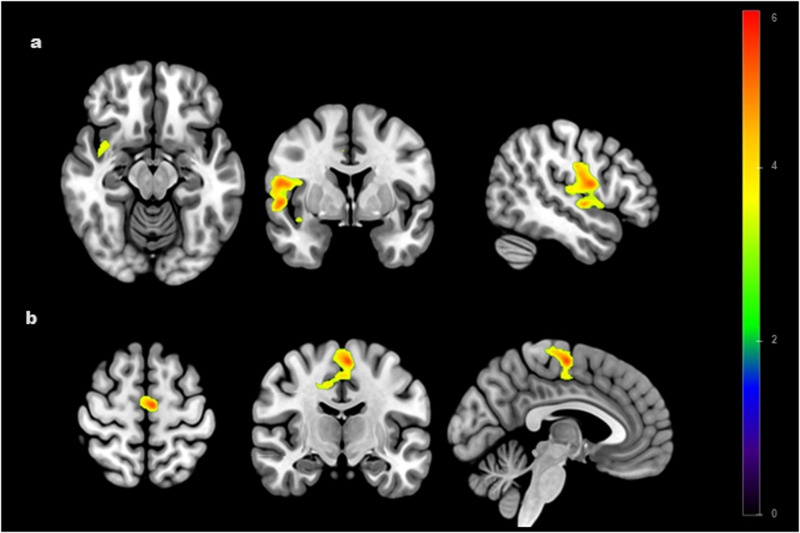 Between-group differences (AN < HC) in the functional connectivity of bilateral nucleus accumbens seeds.Figures (a, b) display lower functional connectivity between the nucleus accumbens and (a) the right insula (NAcc-insula; pFWE < 0.001); (b) the left supplementary motor area (NAcc-SMA; pFWE < 0.001) in the AN group compared to HC. Color bar represents t-values. Results are corrected and displayed at family-wise error (FWE) probability pFWE < 0.05 threshold, cluster-extent. AN anorexia nervosa, HC healthy controls.