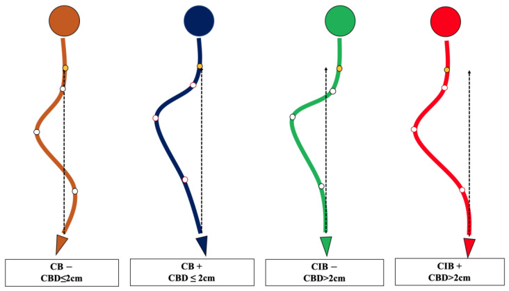 Schematic diagram of the novel coronal balance classification for adult idiopathic scoliosis. CB is diagnosed if CBD ≤ 2 cm, and CIB is diagnosed if CBD > 2 cm. The apical vertebra modifier is defined as negative (−) when CoAVs are on either side of the CSVL. The apical vertebra modifier is defined as positive (+) when CoAVs are on the same side of the CSVL. The yellow dot represents the center of C7, and the white dots represent CoAVs. The dotted arrows represent CSVL.